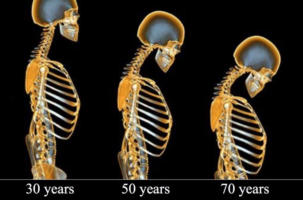 Osteoporose: Wenn Knochen bröseln